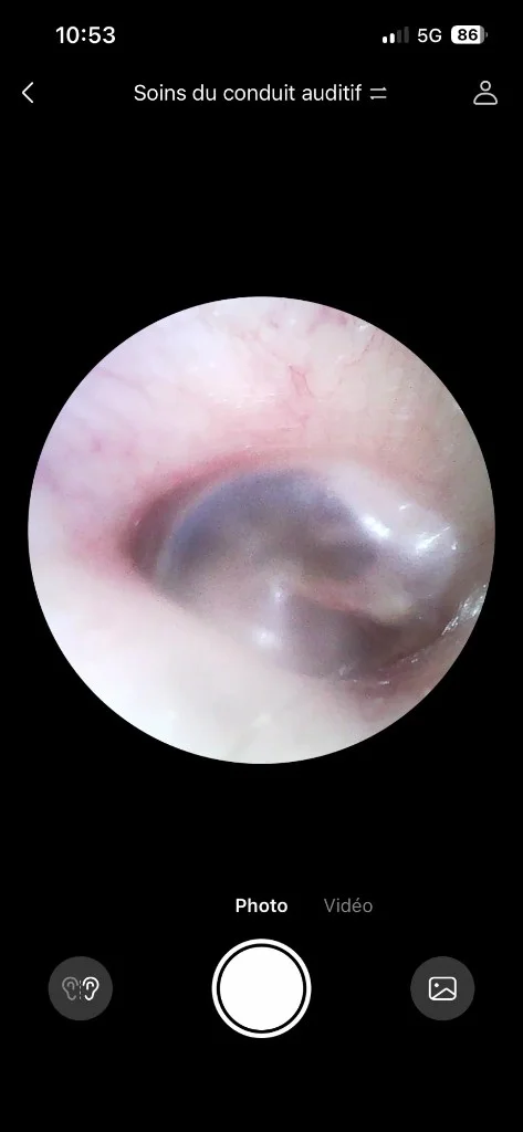 Photo tympan droit prise avec l'otoscope Bebird