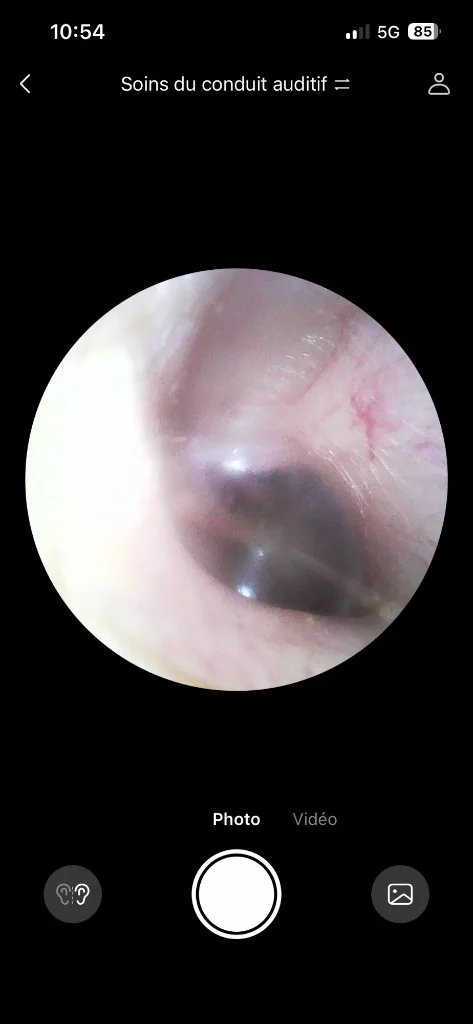 Photo tympan gauche prise avec l'otoscope Bebird